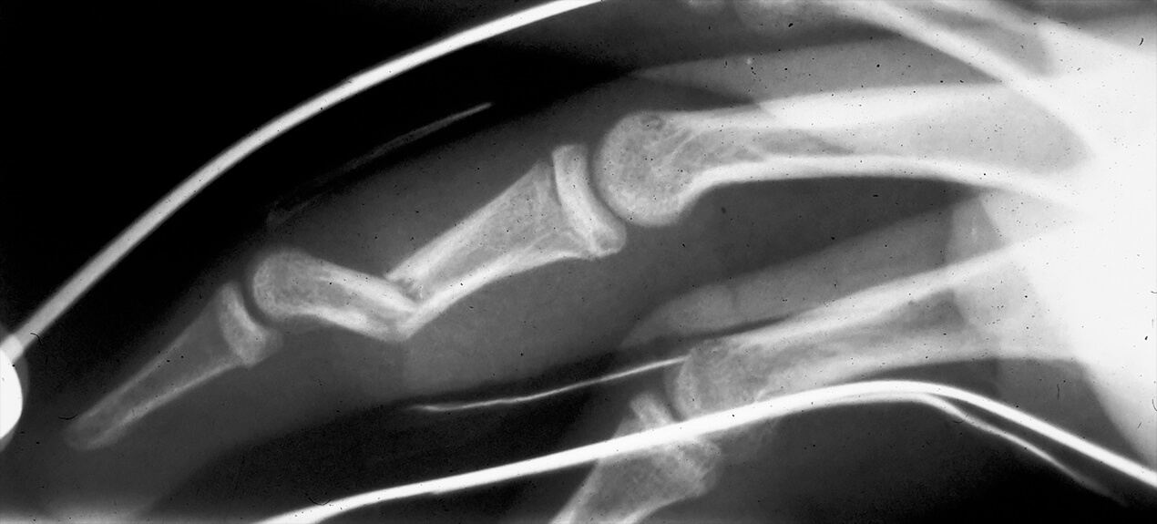 angulated-fracture-middle-phalanx Angulated fracture of middle phalanx finger bone before treatment