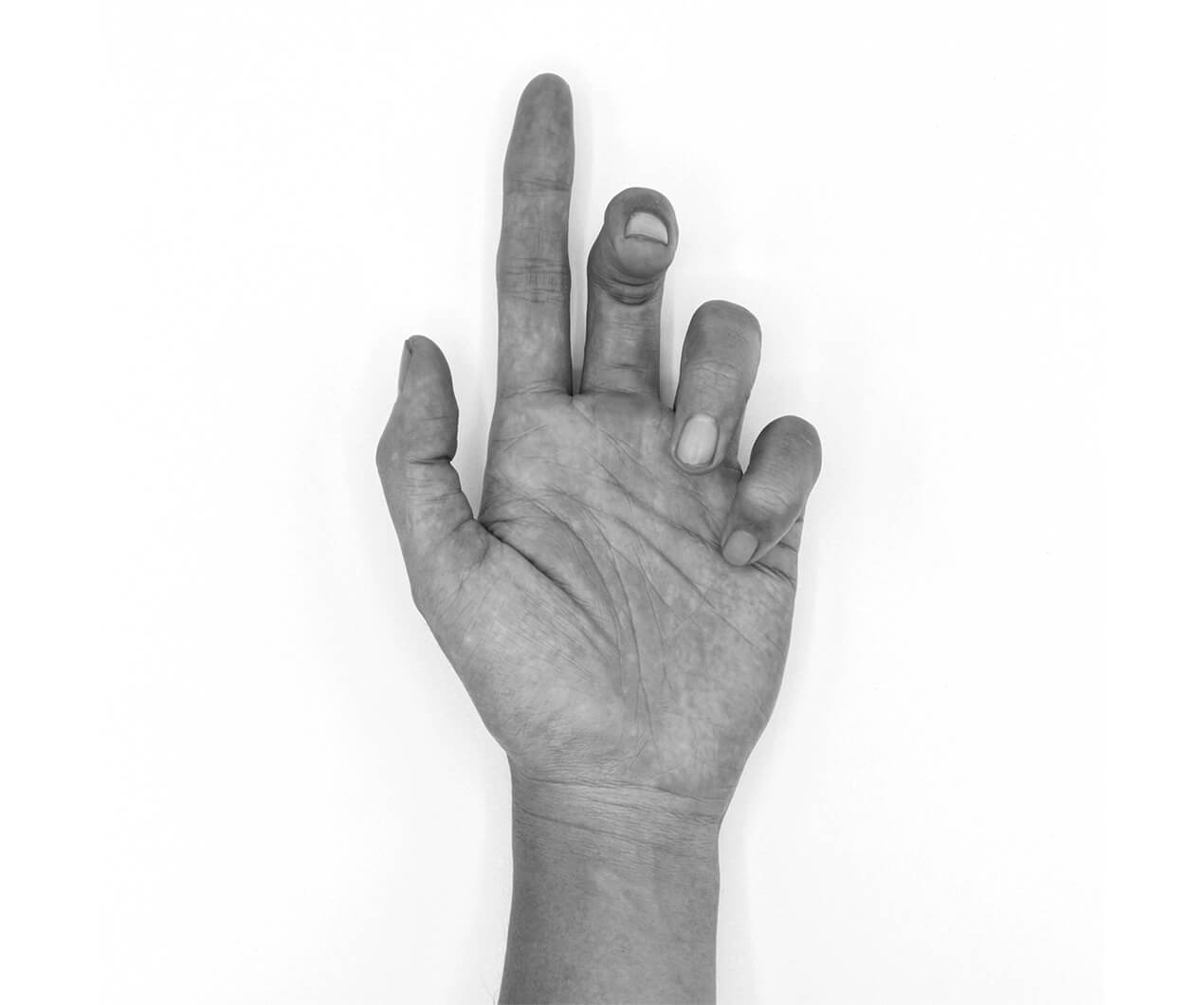 common procedures dupuytrens contracture