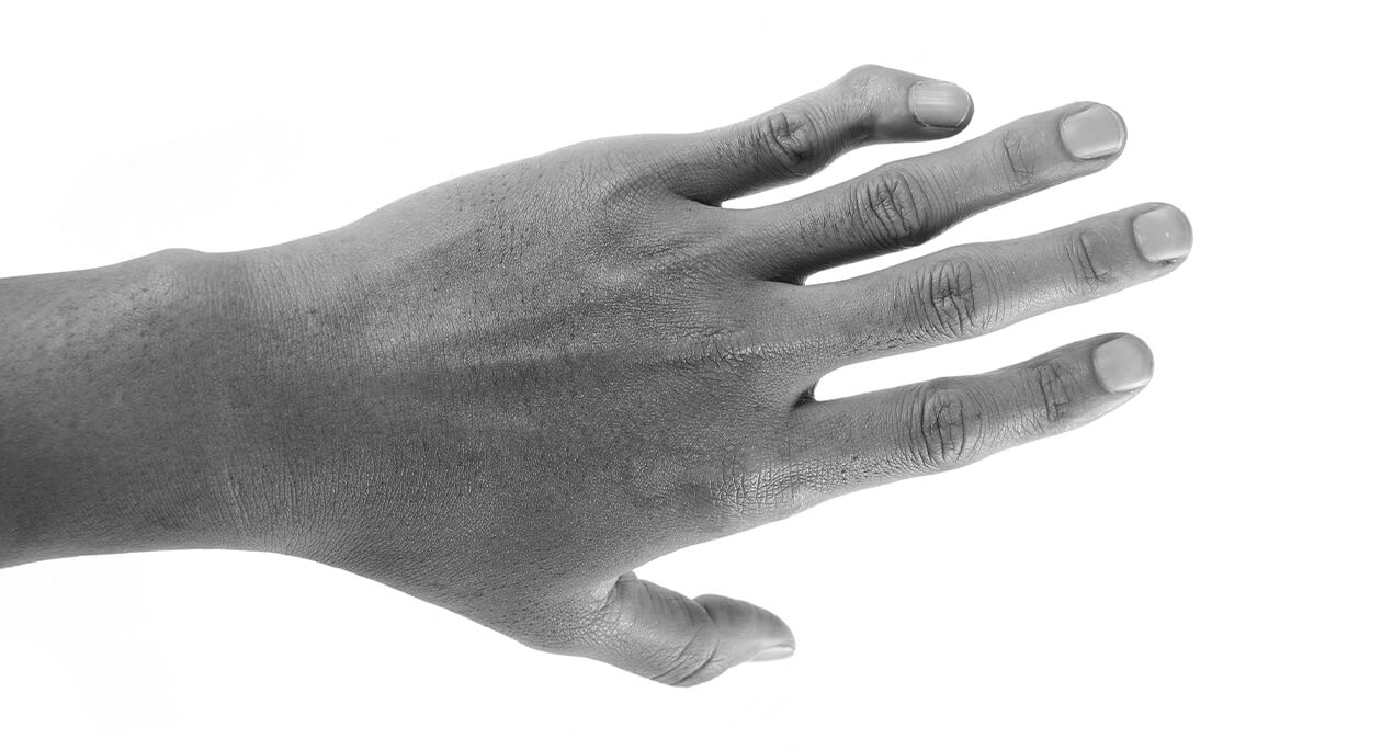 Hand and wrist sports injuries in athletes and active patients