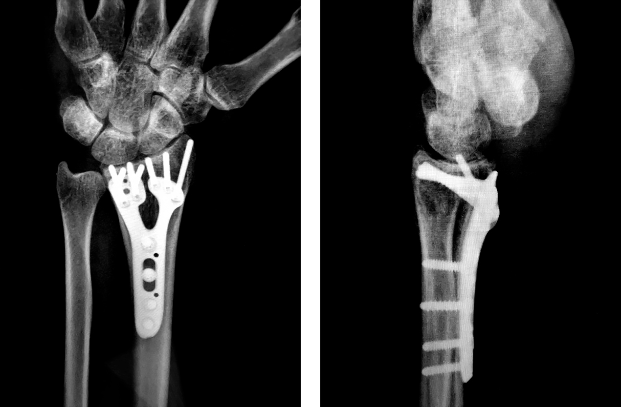 wrist-fracture-plate-fixation Surgical plate fixation for wrist fracture (distal radius fracture treatment)